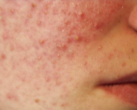 Почему возникают и как проявляются гнойничковые заболевания кожи