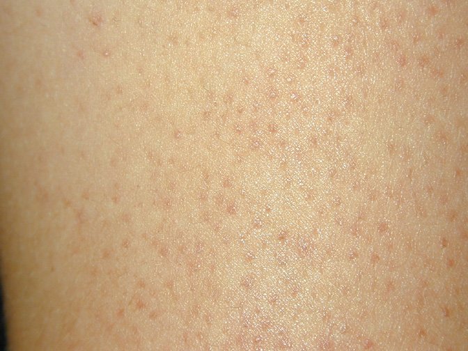 Почему возникает гусиная кожа и как ее лечить