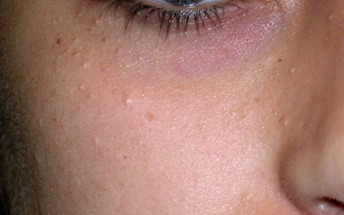 Гиперплазия сальных желез » Клиника косметологии и дерматологии «ACADEMY» — лечение кожи и волос.