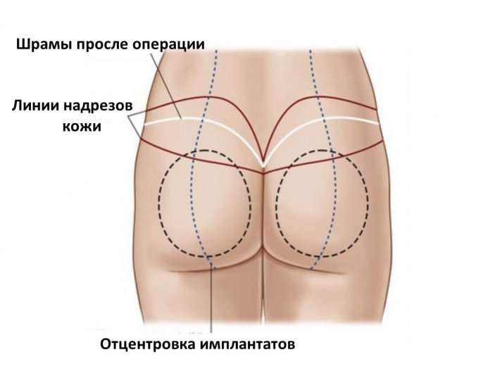 Что к чему:  оценка ситуации  перед пластикой ягодиц